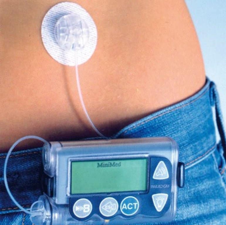 A bordo Tradicion dueño Bombas de insulina para diabetes tipo 2 - Canal Diabetes